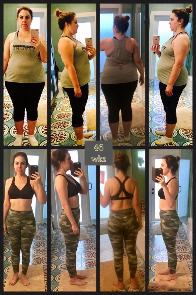 Bariatric Weight Loss Surgery Or Glp-1 Users